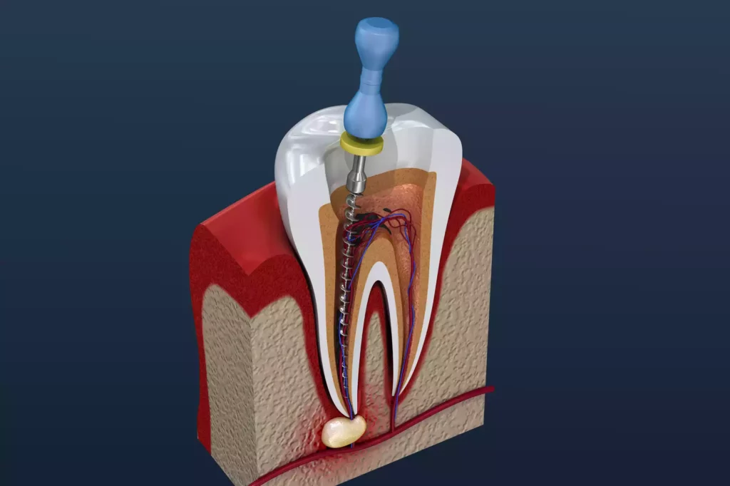 A 3D image of a tooth with endodontic surgery visible.