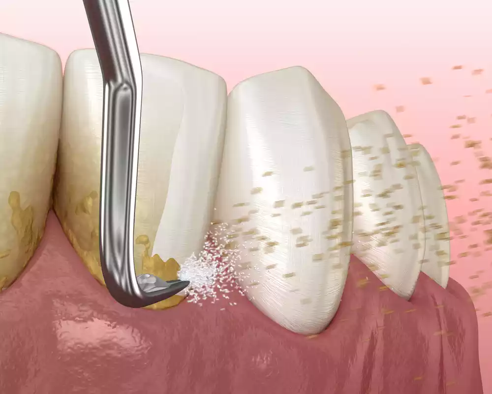 An illustration of a tooth undergoing periodontal cleaning.