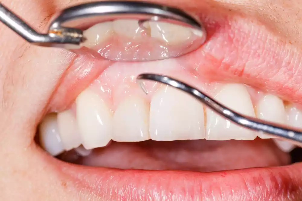 A close up of a person's teeth being examined for healthy gums.