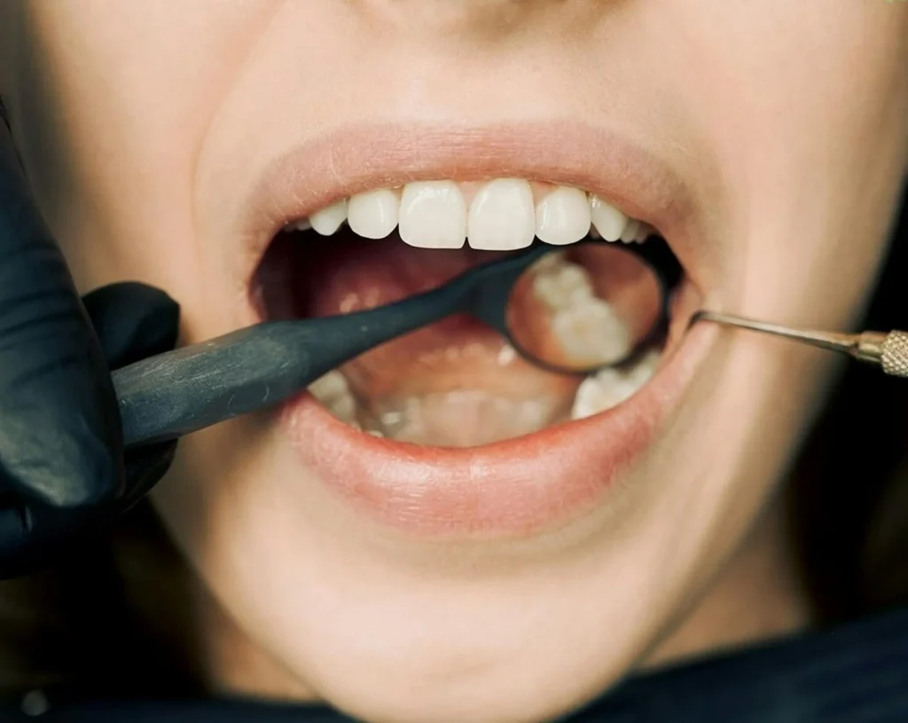 Close-up of a dental examination showing a patient's open mouth with a dentist's tools inspecting the healing time for a tooth extraction.