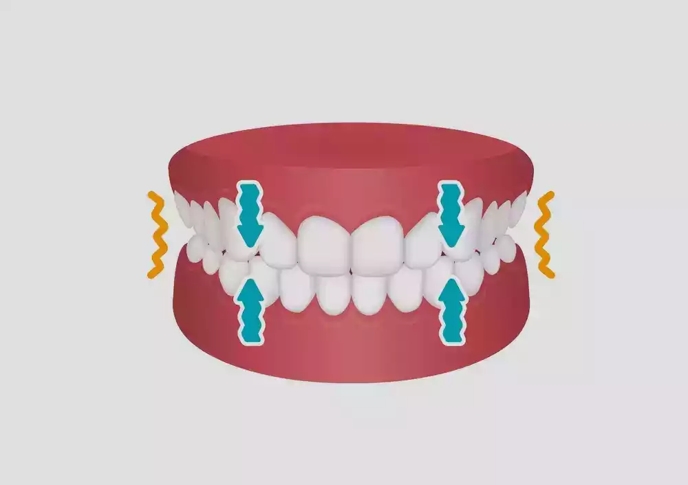 3D illustration of a human lower jaw with teeth, highlighting the movement of four teeth due to orthodontic forces depicted by arrows and brackets, designed to overcome teeth grinding.