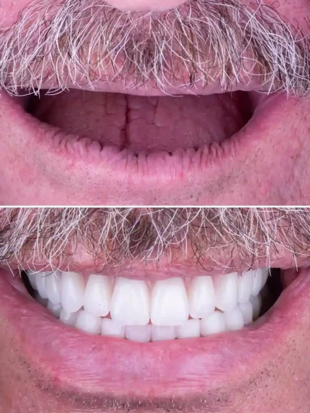 A man's smile transformation with dental veneers featuring All On Six.