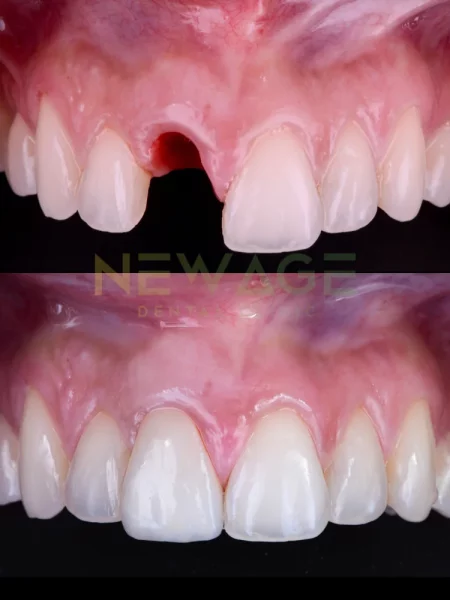 A patient's teeth before and after a dental implant procedure.