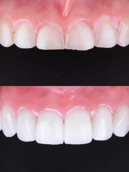 Before and after teeth whitening and veneers.