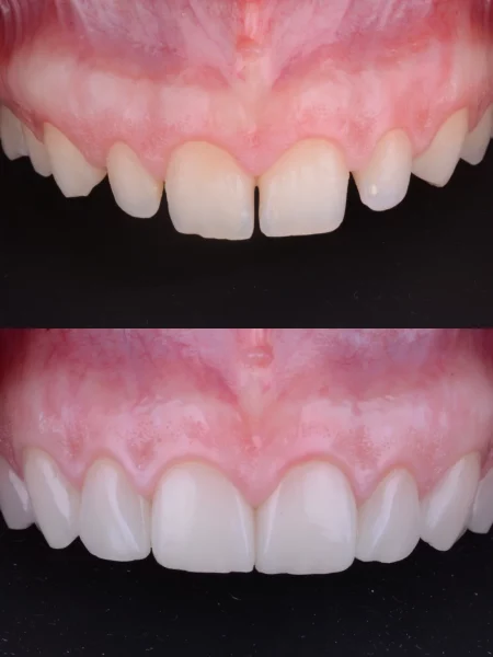 A patient's teeth transform after receiving KR Veneers.